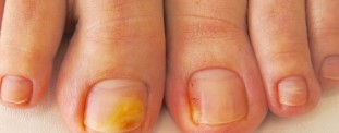 The main features, as well as photos of onychomycosis