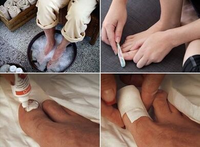 Steaming of the feet and application of urea cream to the nails infected with fungi