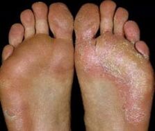 Feet with fungal infection