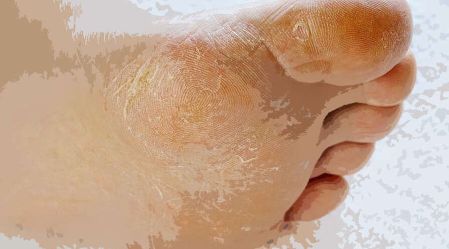 Myositis of the foot