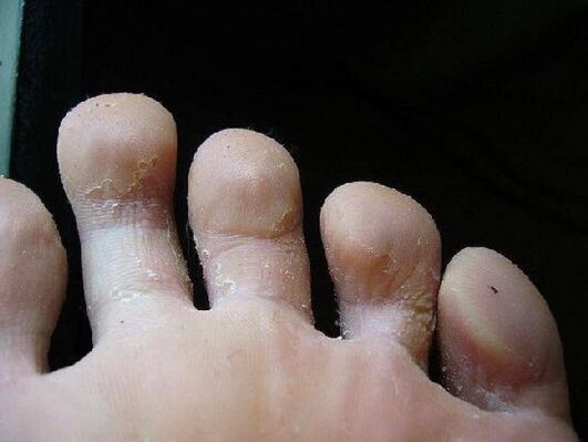 what the fungus looks like on the feet