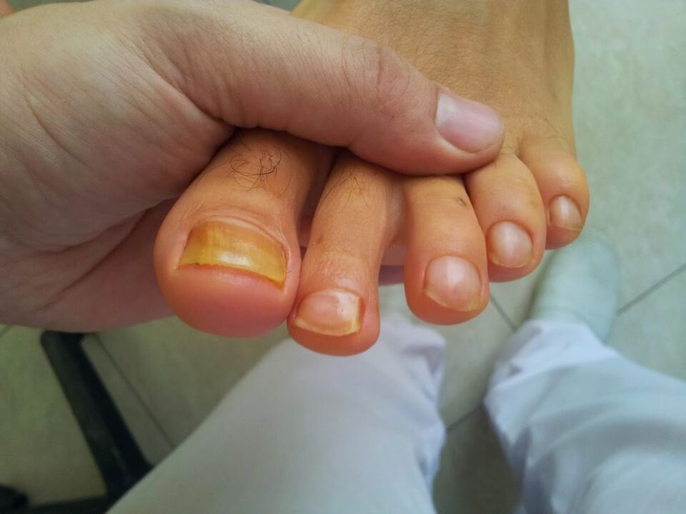 yellowing of toenails with fungi