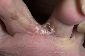 fungus of the skin between the toes