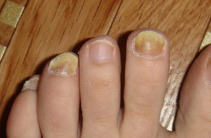 fungus symptoms on the nails and skin of the feet