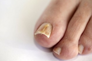fungus of the nails