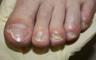 the signs and symptoms of nail fungus