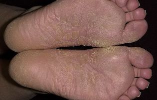 the fungus on your feet